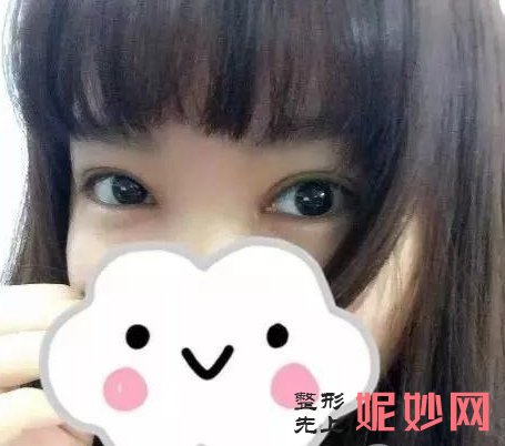 找广州安丽维乔锋丽做双眼皮手术，让小眼睛变成美丽的大眼睛！