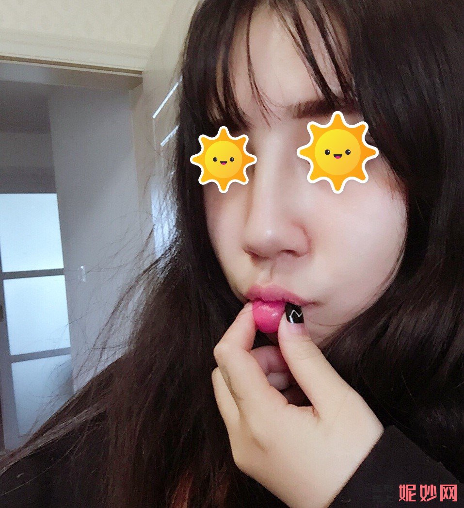 庆幸选择广州安丽维宋午阳做鼻综合，让我拥有漂亮的鼻子！