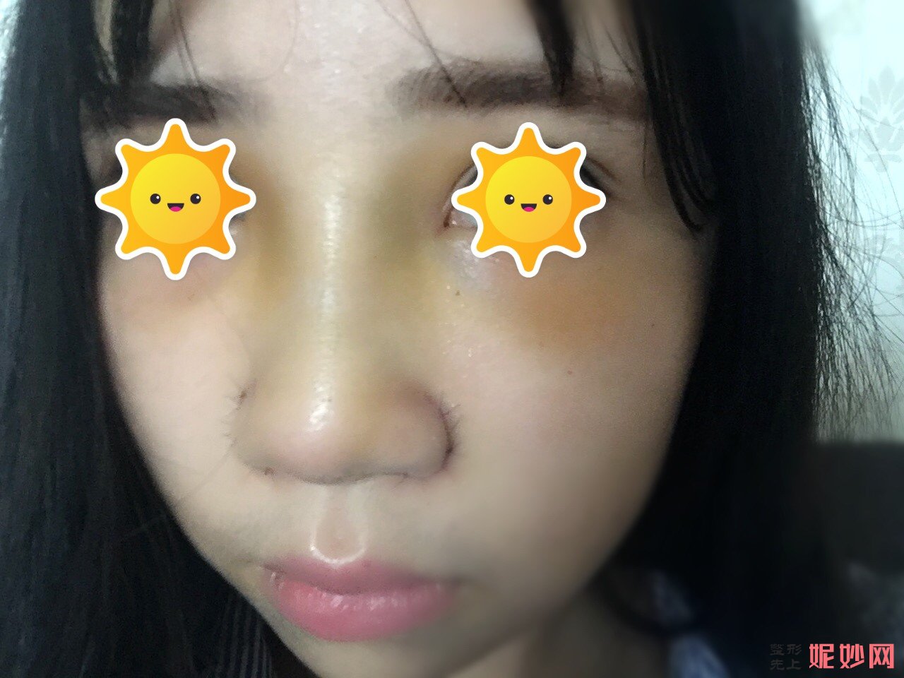 庆幸选择广州安丽维宋午阳做鼻综合，让我拥有漂亮的鼻子！