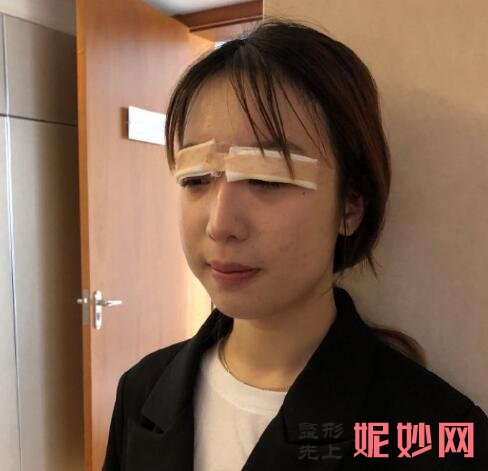 在杭州恒钥医疗做完双眼皮后，整个人发生巨大的变化！