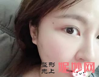 找杭州恒钥张辉做完线雕后，整个人变年轻太多了，也更美了！