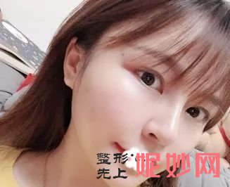 找杭州恒钥张辉做完线雕后，整个人变年轻太多了，也更美了！