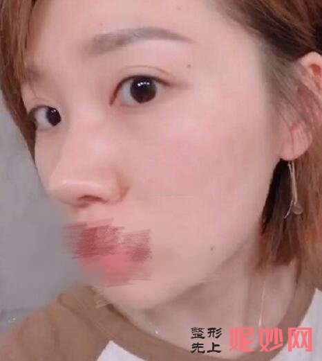 北京春语医疗做祛眼袋案例分享，70天美眼记录来喽！