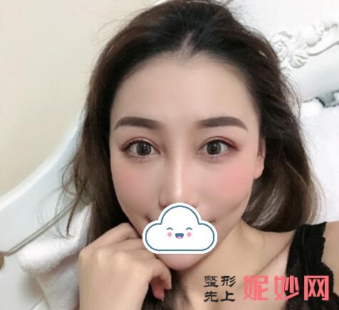 看面部自体脂肪填充恢复后90天恢复图，合肥春语医疗让容颜更漂亮!