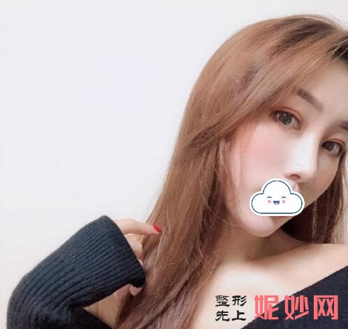 看面部自体脂肪填充恢复后90天恢复图，合肥春语医疗让容颜更漂亮!