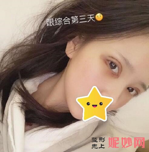 合肥美希淑颜医疗做的全切综合眼案例效果图大公开，让眼睛变得更精致！