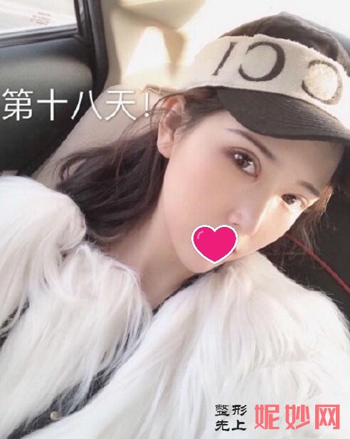 合肥美希淑颜医疗做的全切综合眼案例效果图大公开，让眼睛变得更精致！