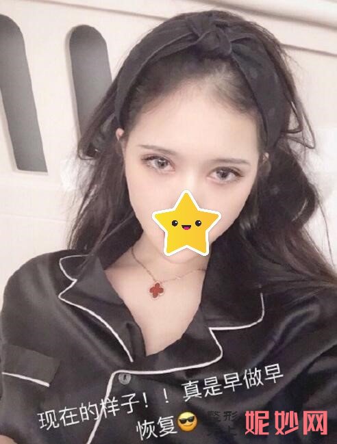 合肥美希淑颜医疗做的全切综合眼案例效果图大公开，让眼睛变得更精致！