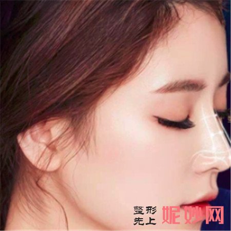 隆鼻适合哪些人？重庆当代整形隆鼻怎么样？