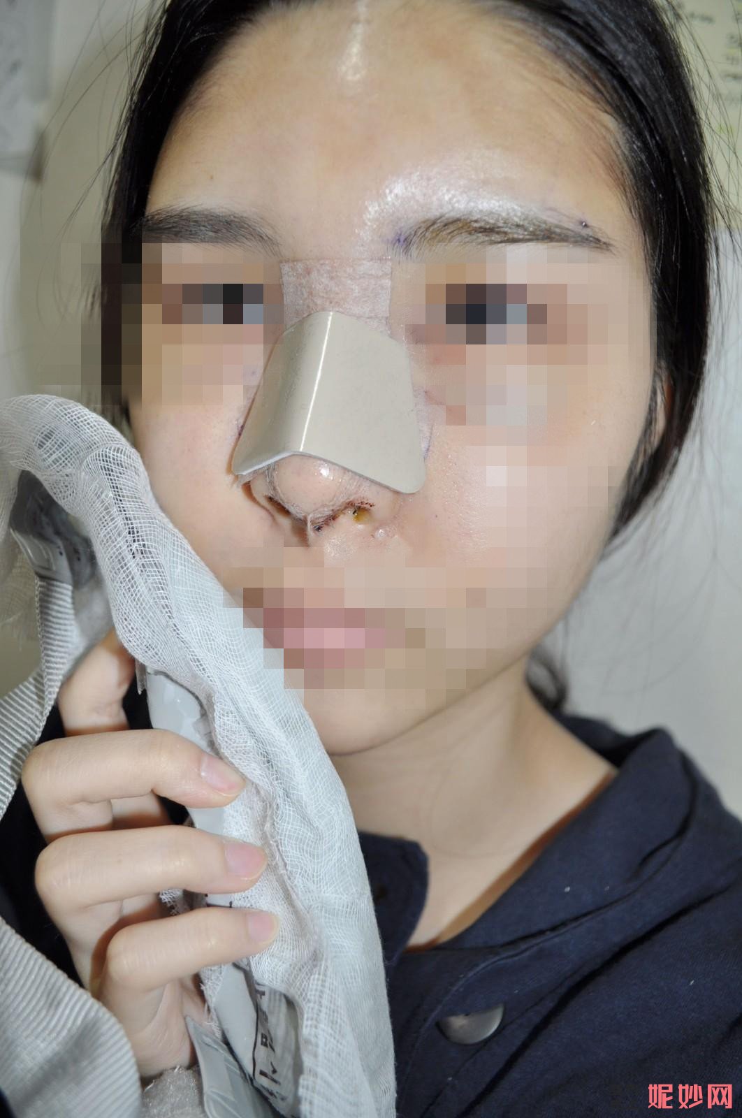 高顺福做鼻子怎么样？真实测评来喽，快来看看真实效果！