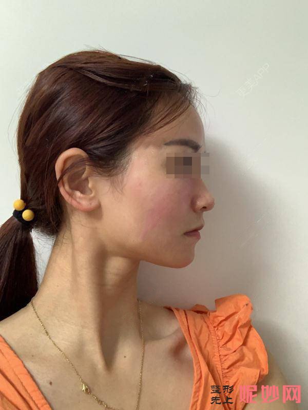 唐美人医疗整形美容医院怎么样？医生介绍+面部除皱案例分享