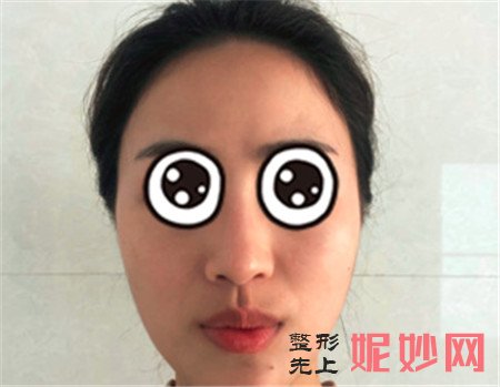王旭明医生做的鼻子怎么样？