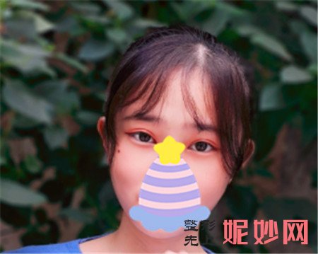 邹大龙双眼皮怎么样？