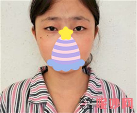 邹大龙双眼皮怎么样？