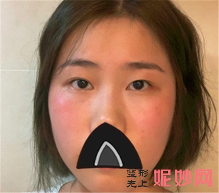 谢锦清做双眼皮怎么样？