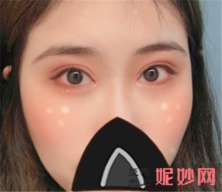 谢锦清做双眼皮怎么样？