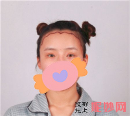颉玉胜植发怎么样？