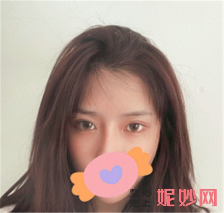 颉玉胜植发怎么样？