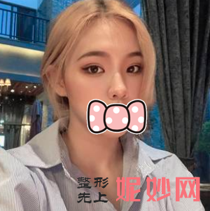 于晓波双眼皮修复怎么样？