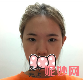 于晓波双眼皮修复怎么样？