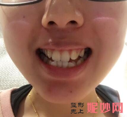 北京丽都医疗美容医院遇海波牙齿矫正怎么样？牙齿整齐，好开心！