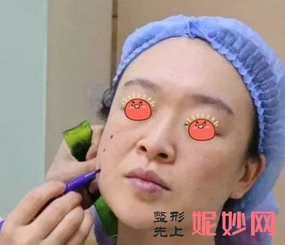 北京丽都医疗美容医院高艳注射除皱怎么样？感觉不错，没有不良反应！