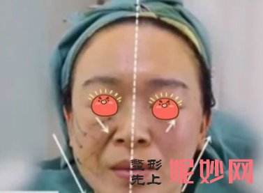 北京丽都医疗美容医院高艳注射除皱怎么样？感觉不错，没有不良反应！