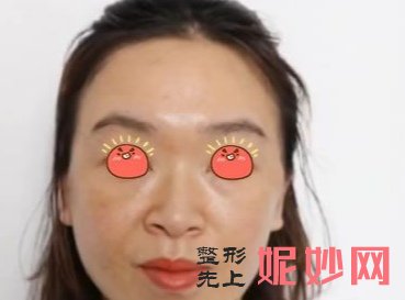 北京丽都医疗美容医院高艳注射除皱怎么样？感觉不错，没有不良反应！