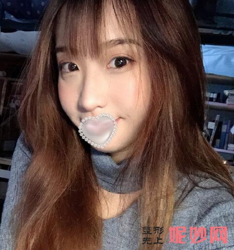 北京丽都医疗美容医院曹卫华双眼皮效果怎么样？双眼皮的我更漂亮！