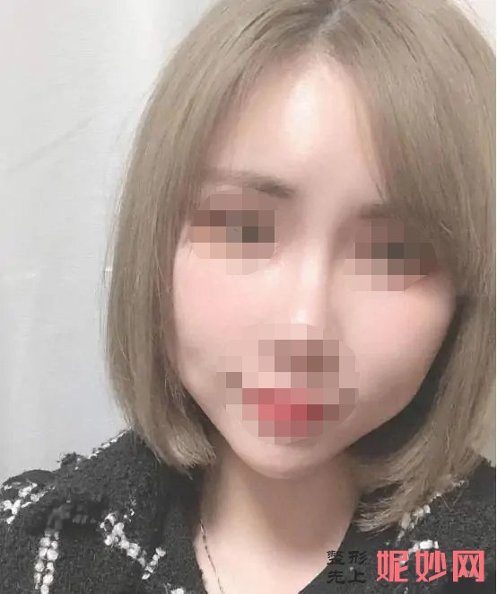 北京丽都医疗美容医院于晓春线雕怎么样？效果很理想，已推荐给小姐妹！