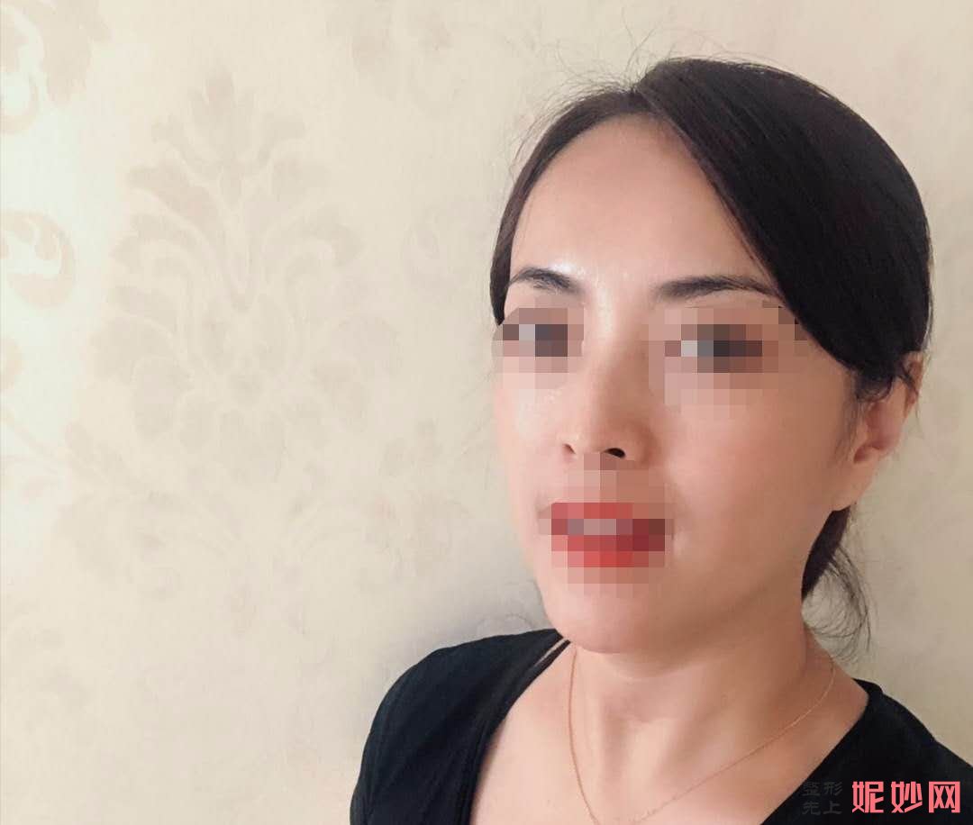 北京丽都医疗美容医院于晓春线雕怎么样？效果很理想，已推荐给小姐妹！
