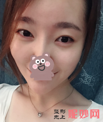 胡晓根脂肪填充怎么样？