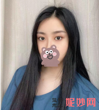 胡晓根双眼皮价格？