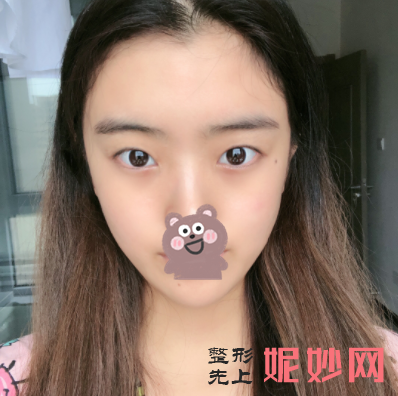 付小卒做双眼皮怎么样？