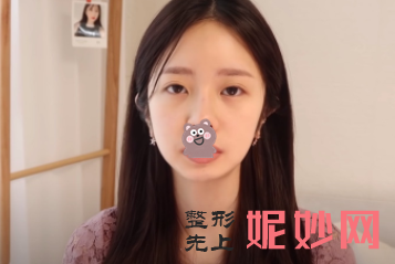 高占巍颧骨内推怎么样？