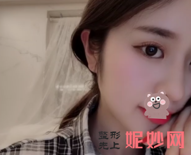 高占巍颧骨内推怎么样？