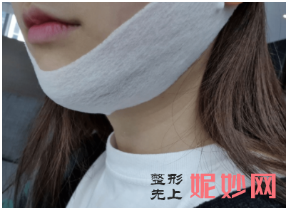 高占巍颧骨内推怎么样？