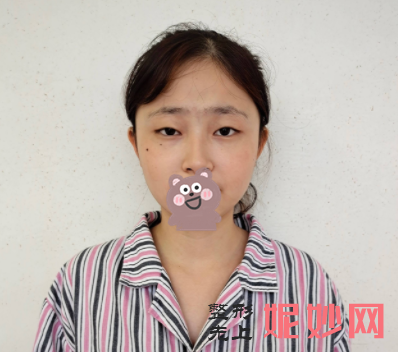 吴玉家双眼皮修复做的好么？