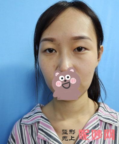 吴玉家双眼皮做得好么？