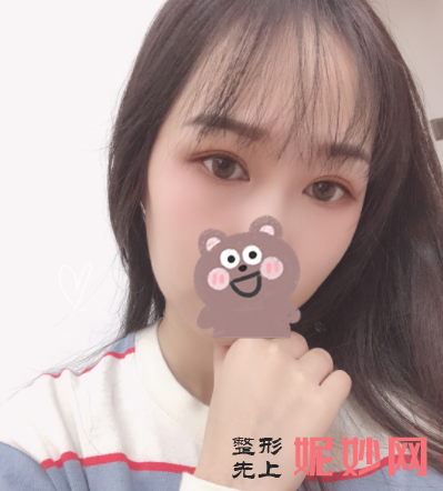 吴玉家双眼皮做得好么？