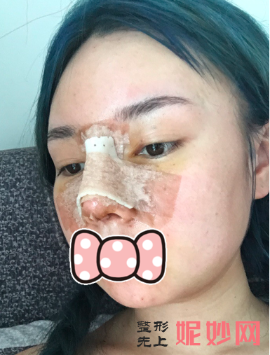 曾高做鼻子怎么样？