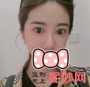 曾高做鼻子到底怎样？