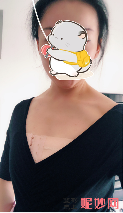 曾昂做的隆胸术怎么样？