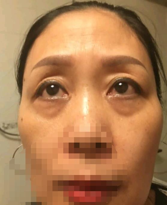伊美尔做眼袋怎么样？附上院内相关案例