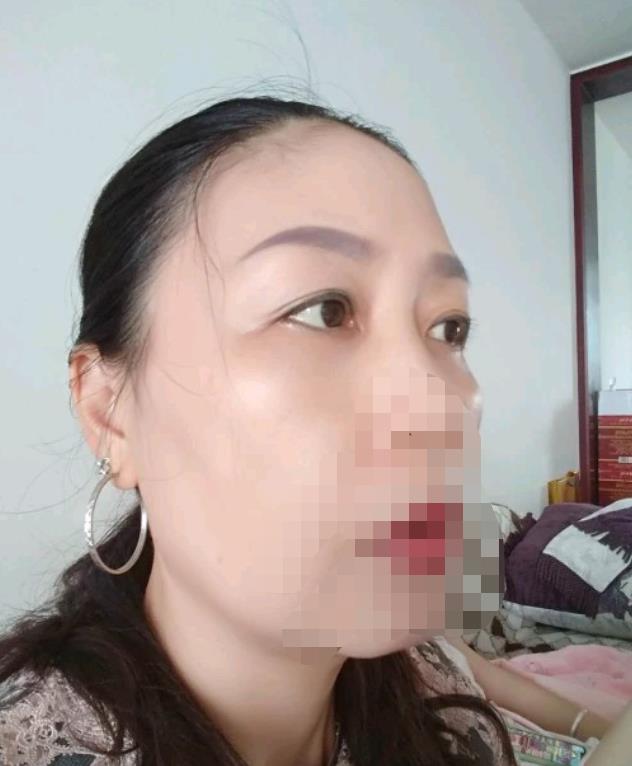 伊美尔做眼袋怎么样？附上院内相关案例