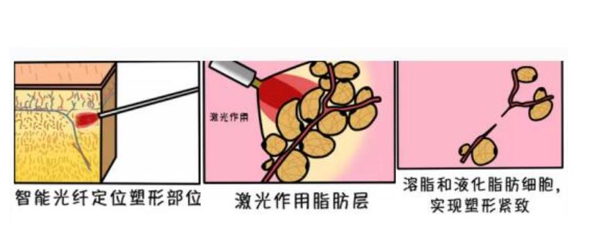 共振吸脂减肥效果怎么样？相关人士介绍