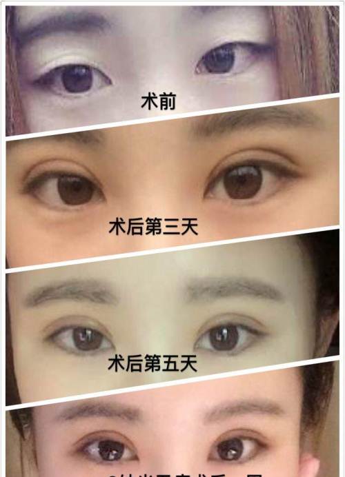韩式翘睫双眼皮的做法