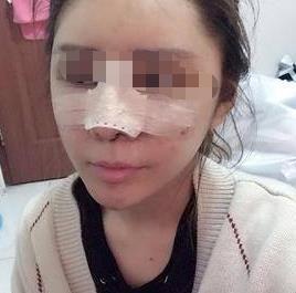 北京哪里做鼻子好，附隆鼻案例分享！