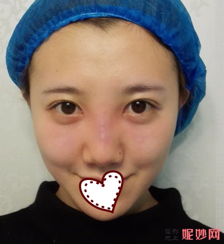 东莞美熙伊美医院正规吗？医生介绍+鼻综合案例分享+价格表