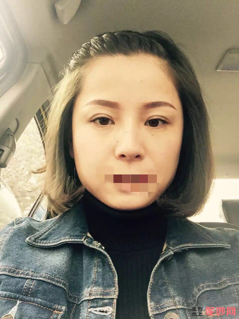 广州智媄医疗整形好吗？医生介绍~面部提拉手术案例分享+价格表